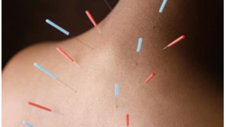 Improve Sport Performance with Acupuncture | Body Option Clinic